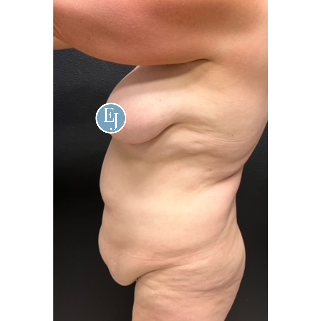Before and after images of individual who received a Mommy makeover in sarasota by Dr. Emily Jiles