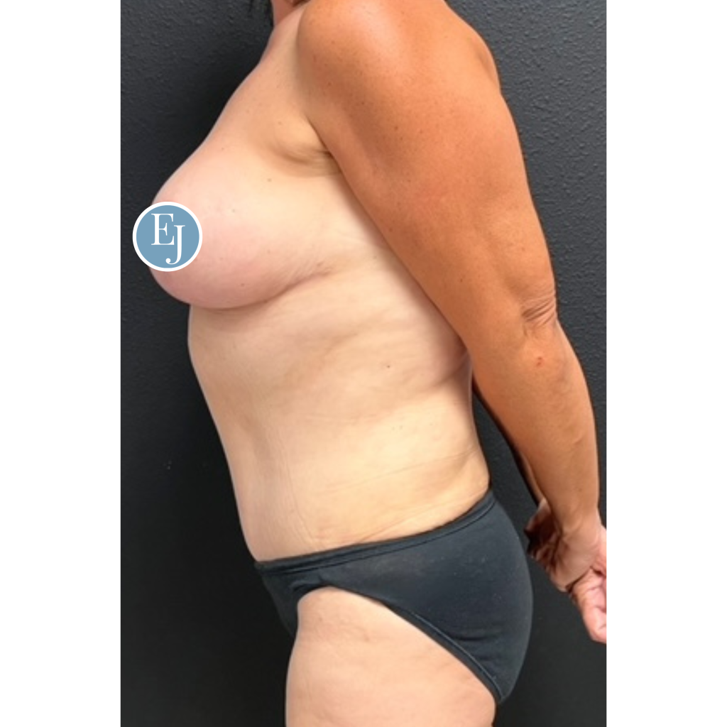 Before and after images of individual who received a Mommy makeover in sarasota by Dr. Emily Jiles