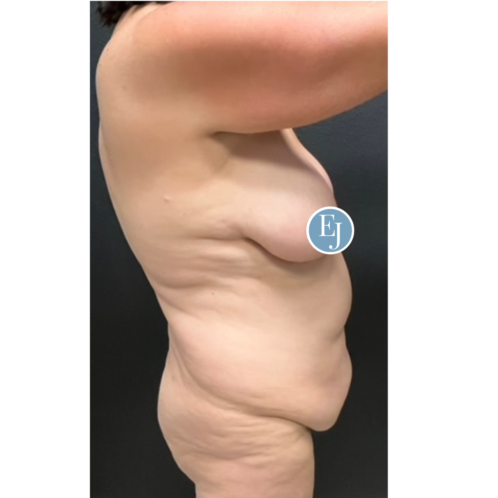 Before and after images of individual who received a Mommy makeover in sarasota by Dr. Emily Jiles