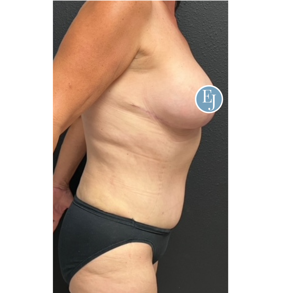 Before and after images of individual who received a Mommy makeover in sarasota by Dr. Emily Jiles