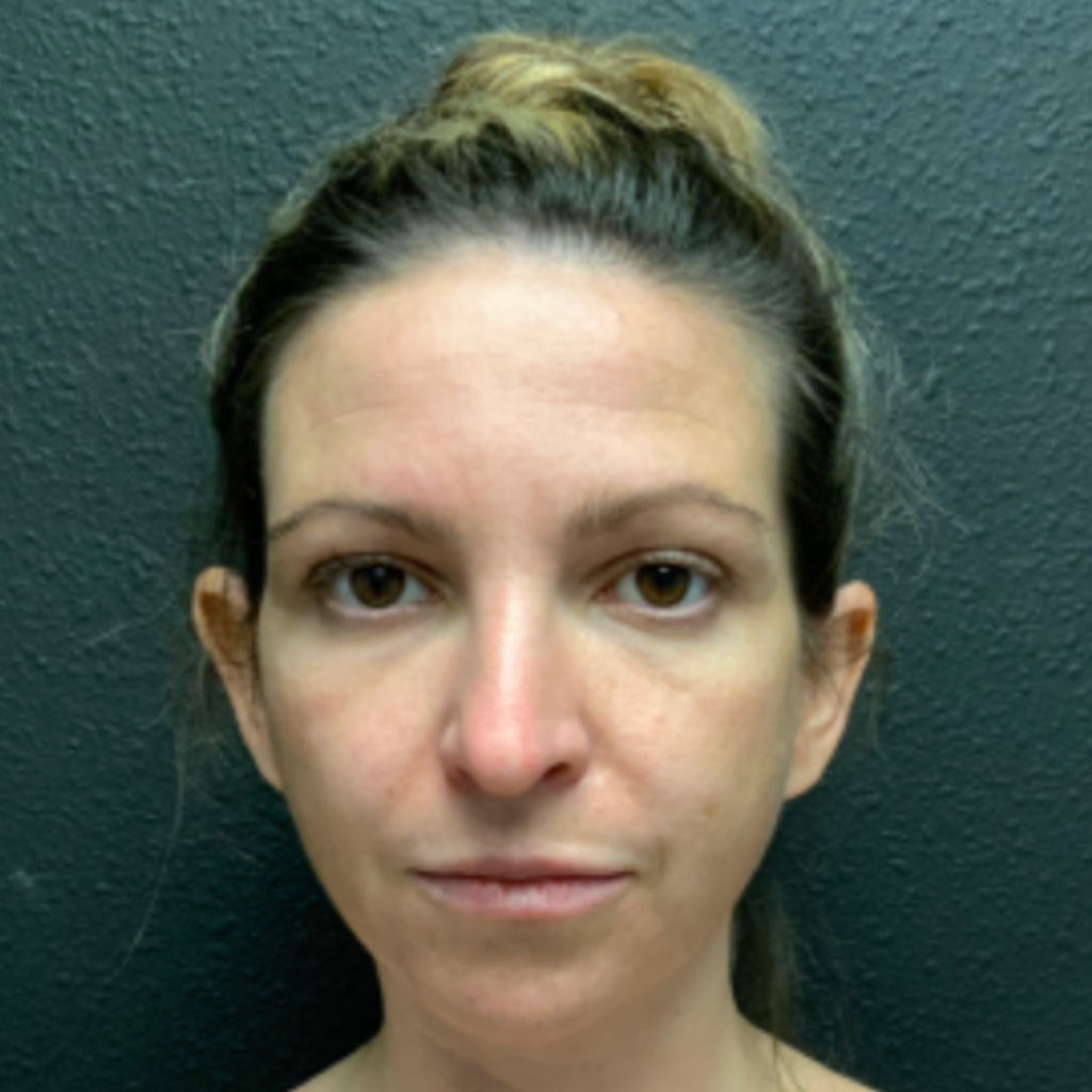 11 - Otoplasty before