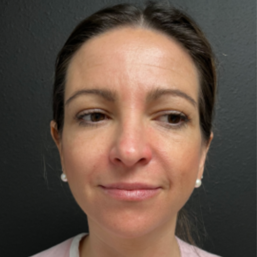 12 - Otoplasty after