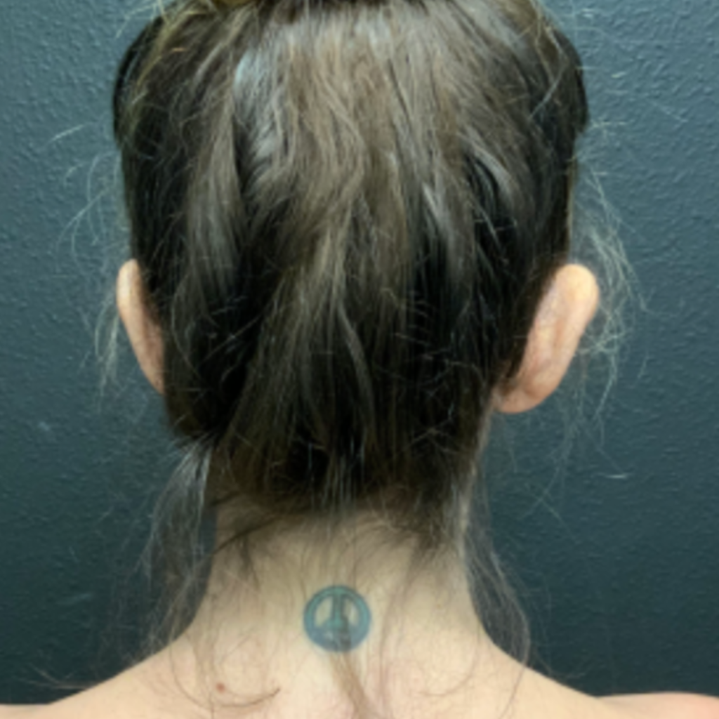 15 - Otoplasty before