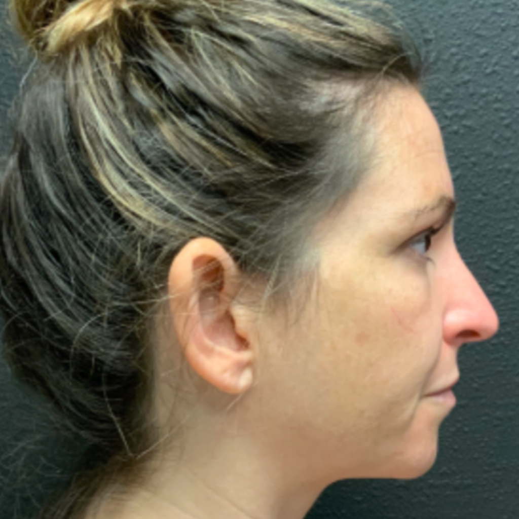 17 - Otoplasty before