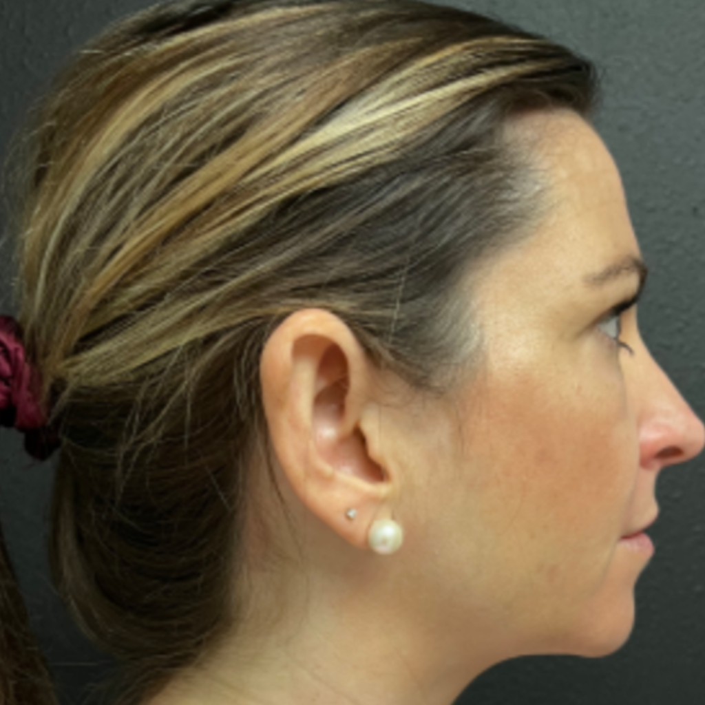 18 - Otoplasty after