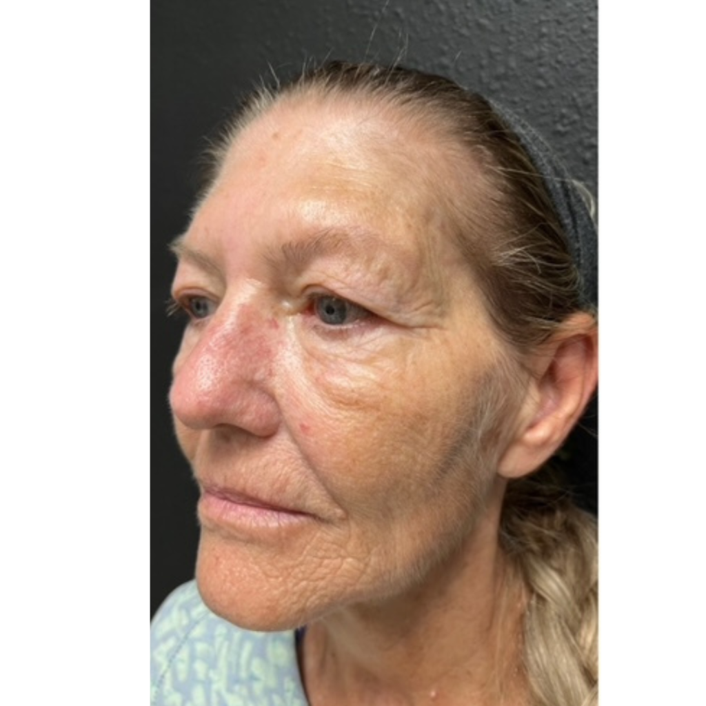 upper blepharoplasty before photo