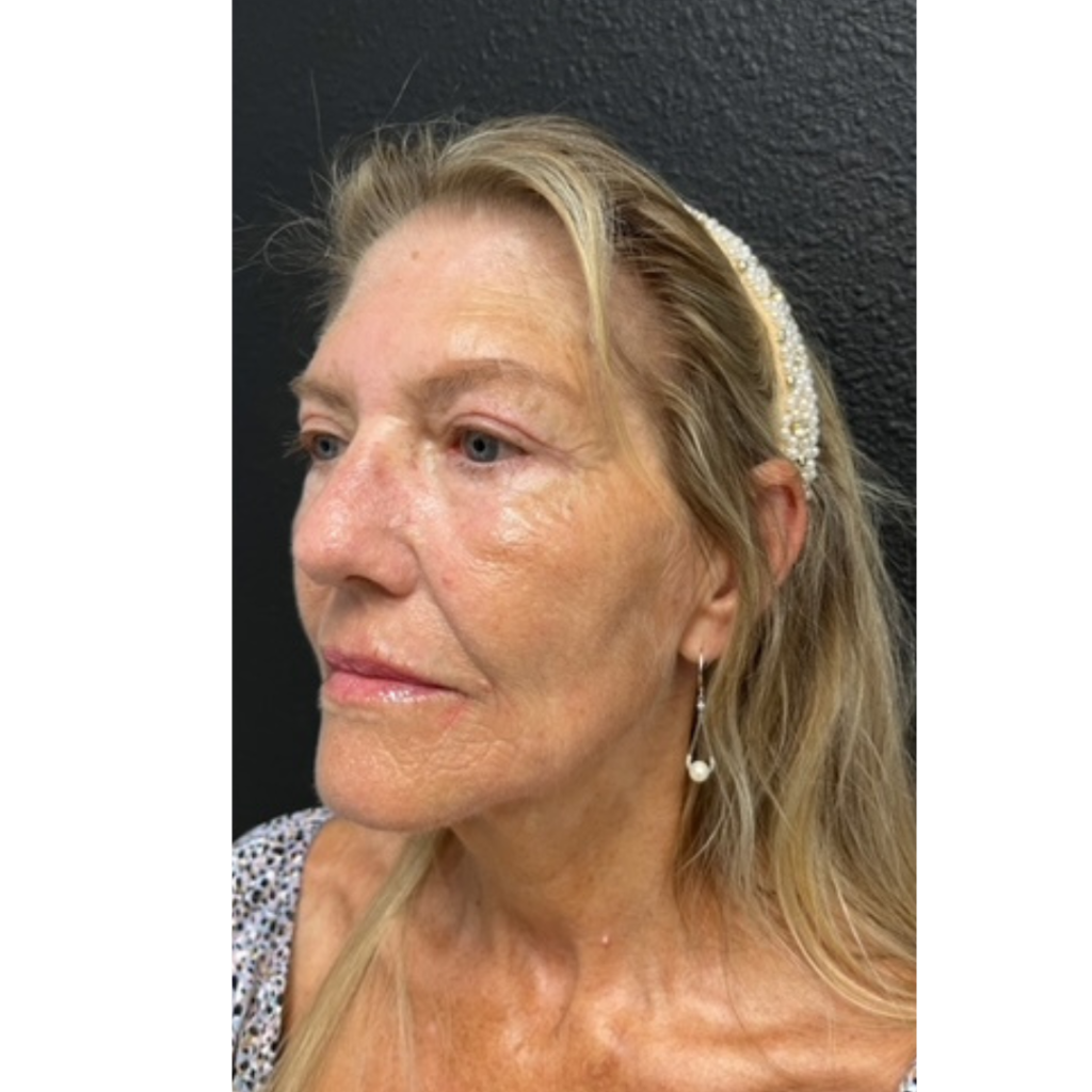 upper blepharoplasty after photo