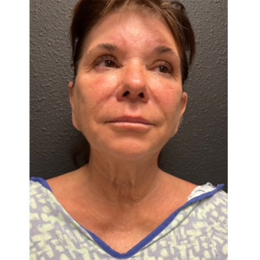 Facelift before