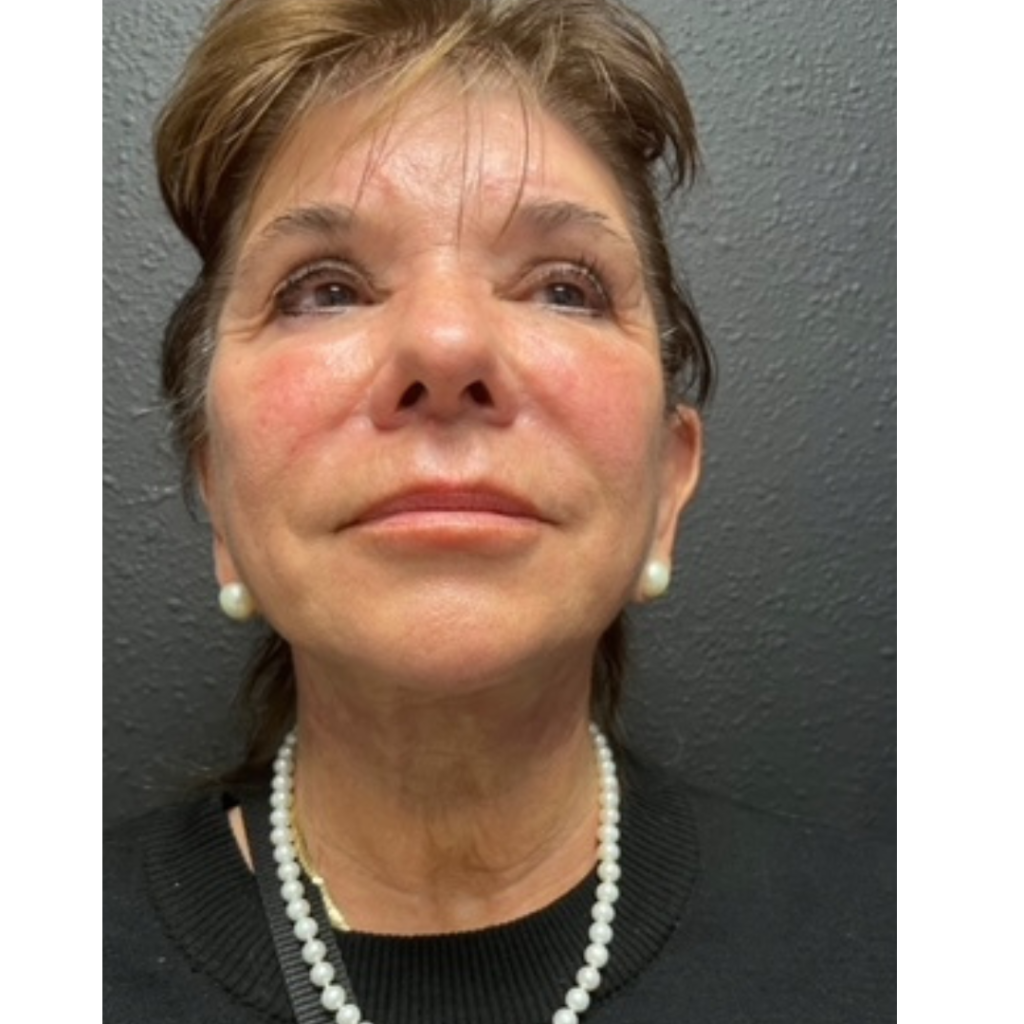 Facelift after