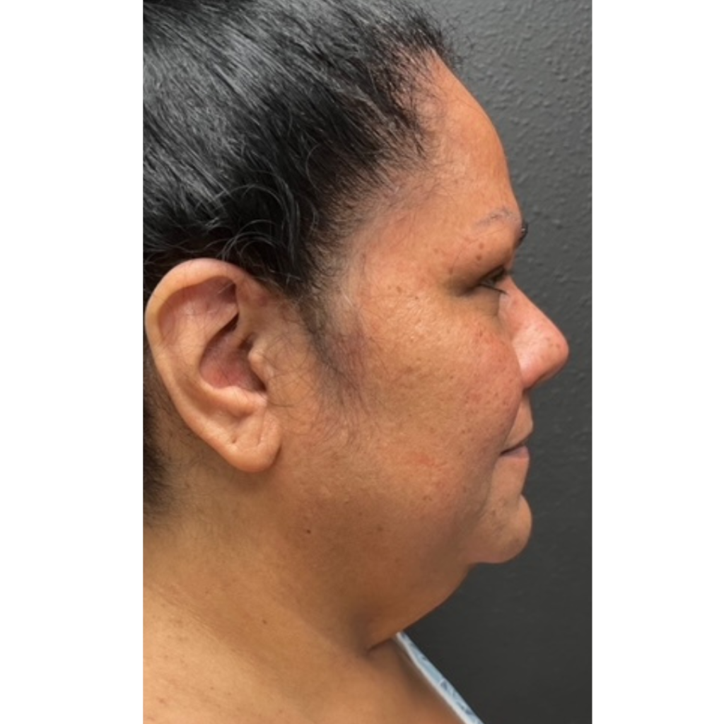 24-1 - Facelift before