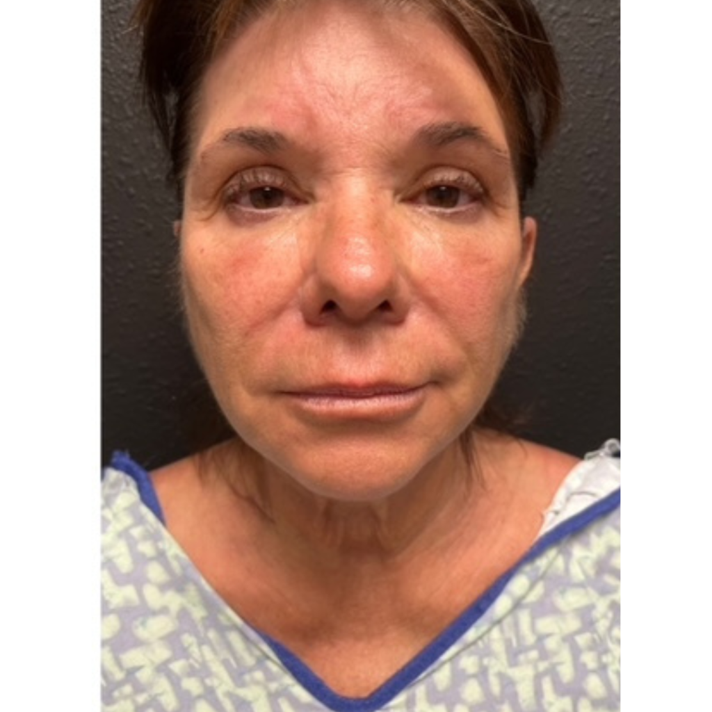 Facelift before
