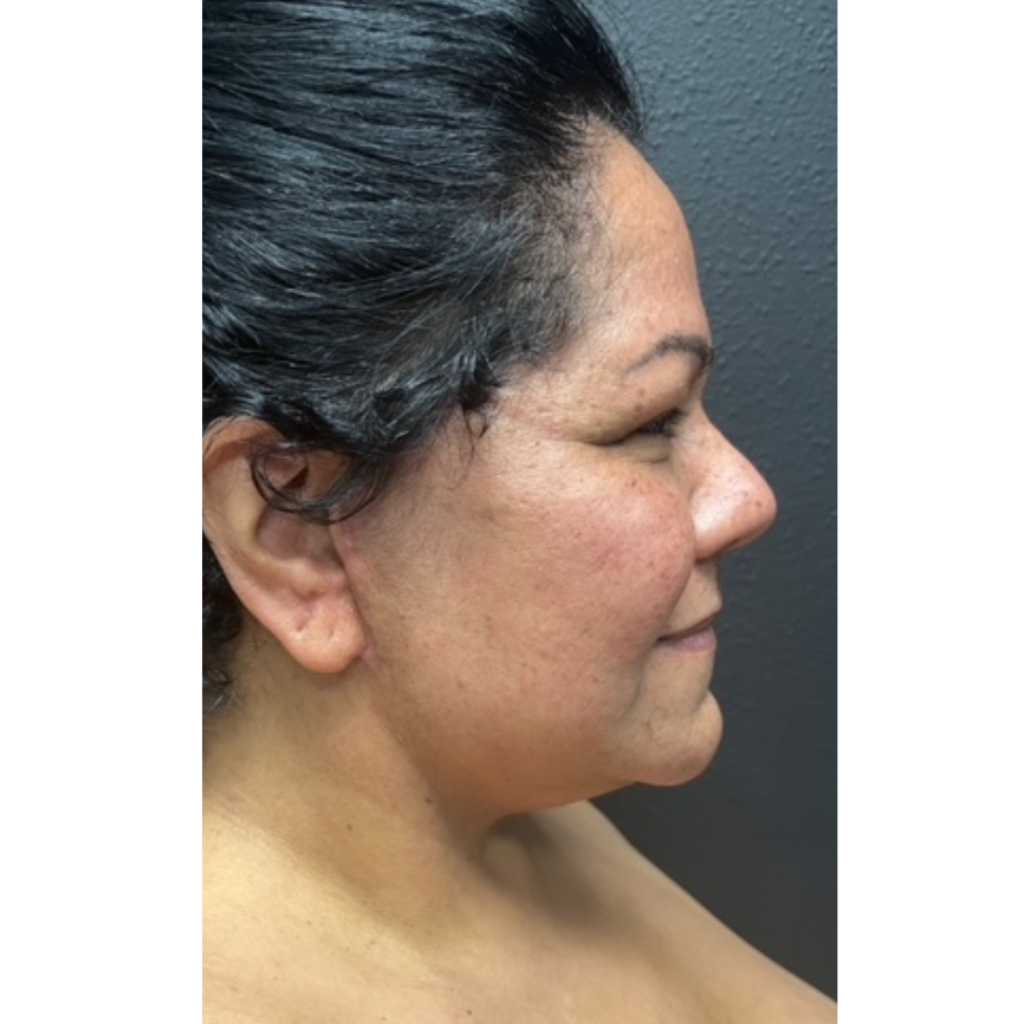 25-1 - Facelift after