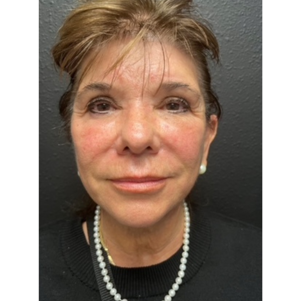Facelift after