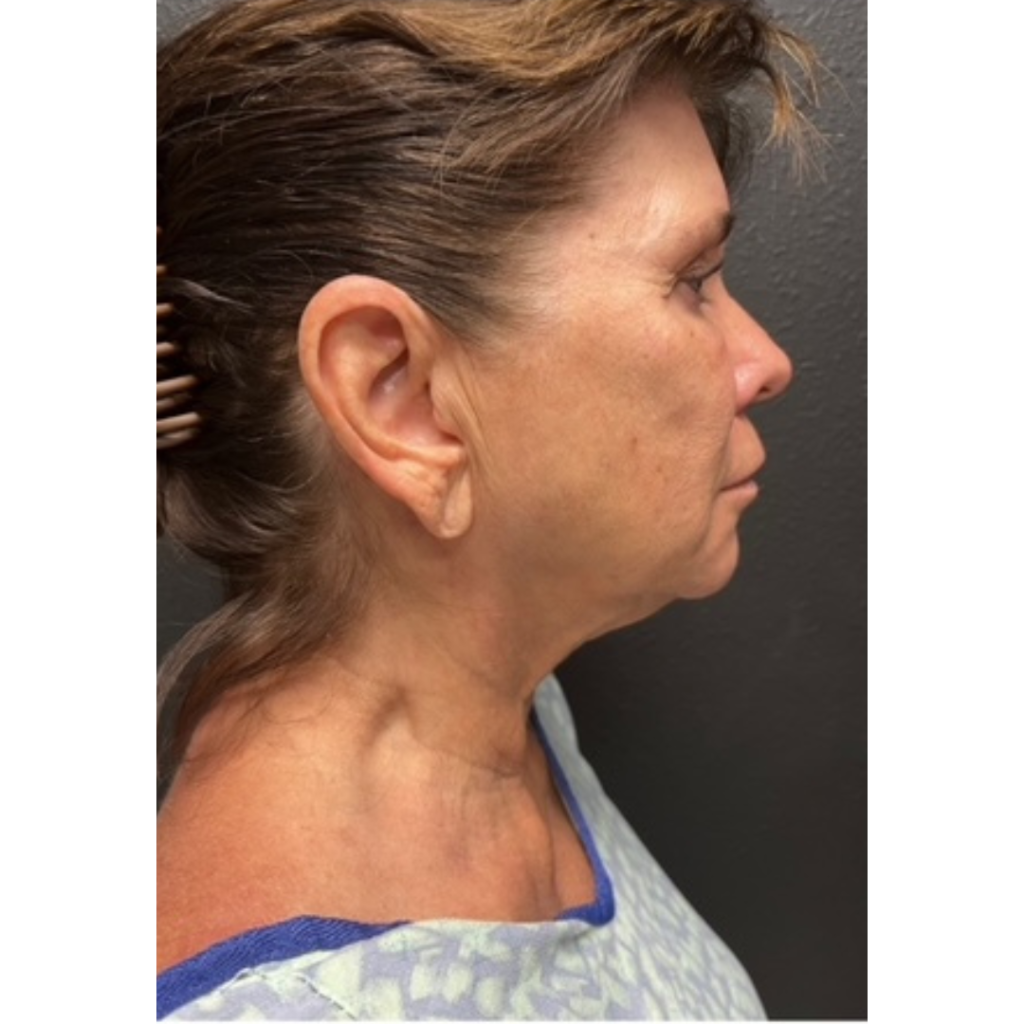 Facelift before