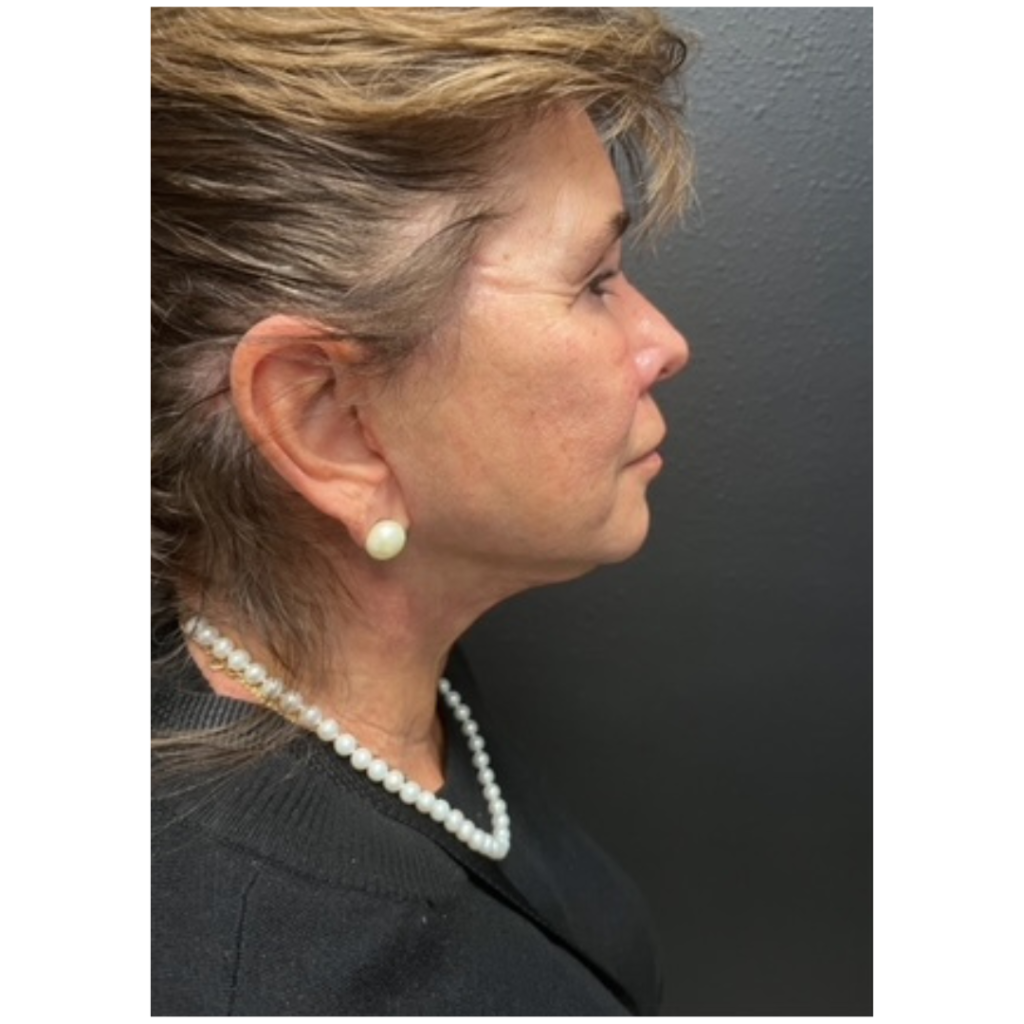 Facelift after