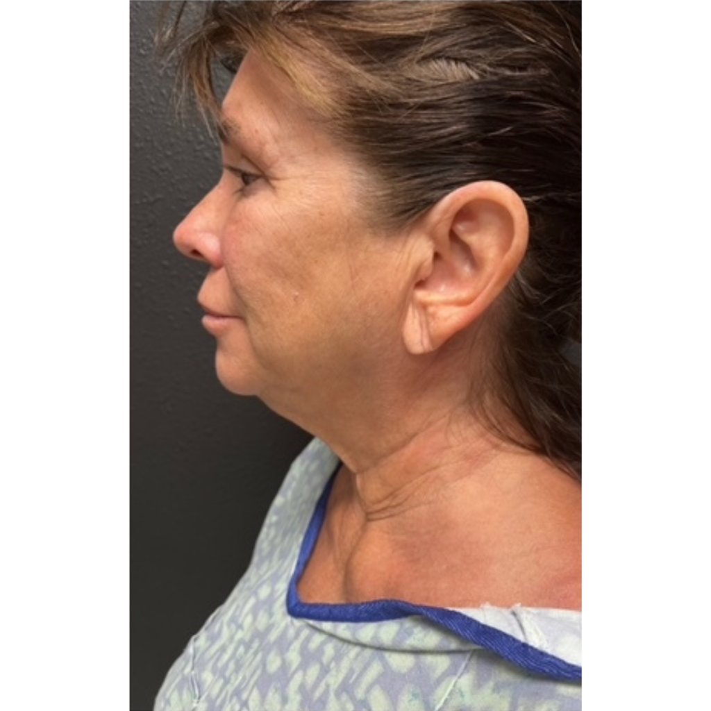 28 - Facelift before