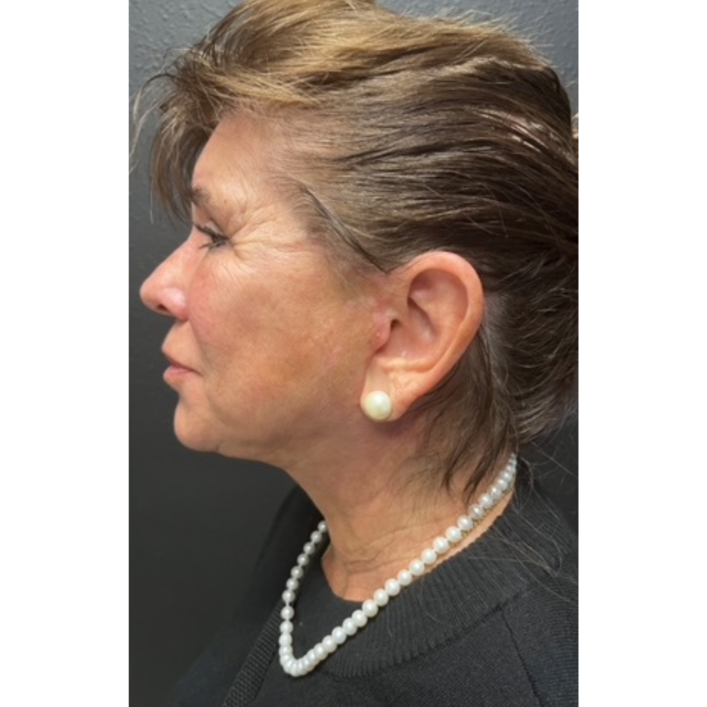 29 - Facelift after