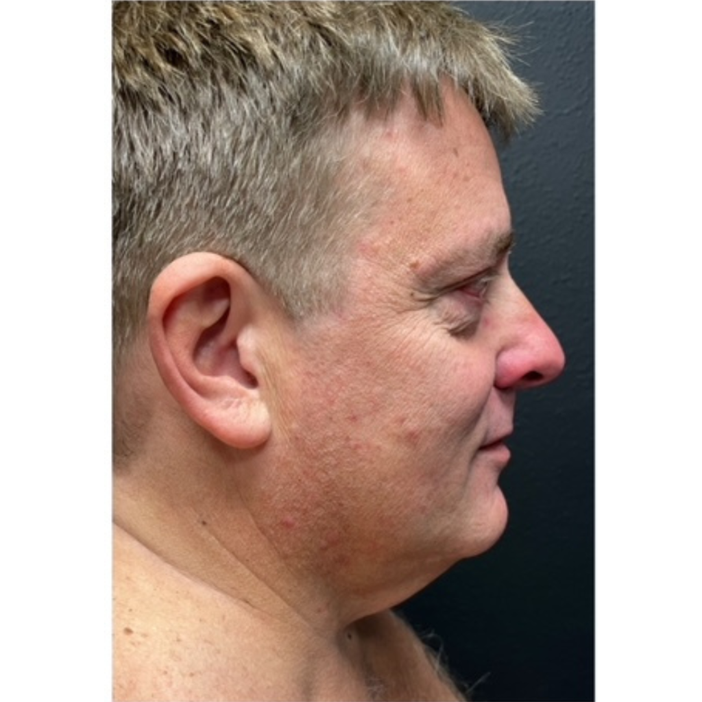 196 - Facelift before