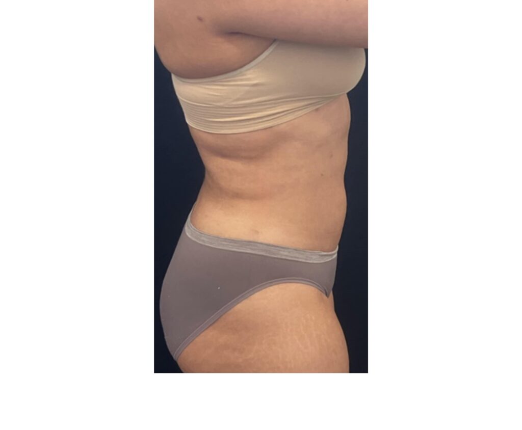 Mini Tummy Tuck with Lipo - After
