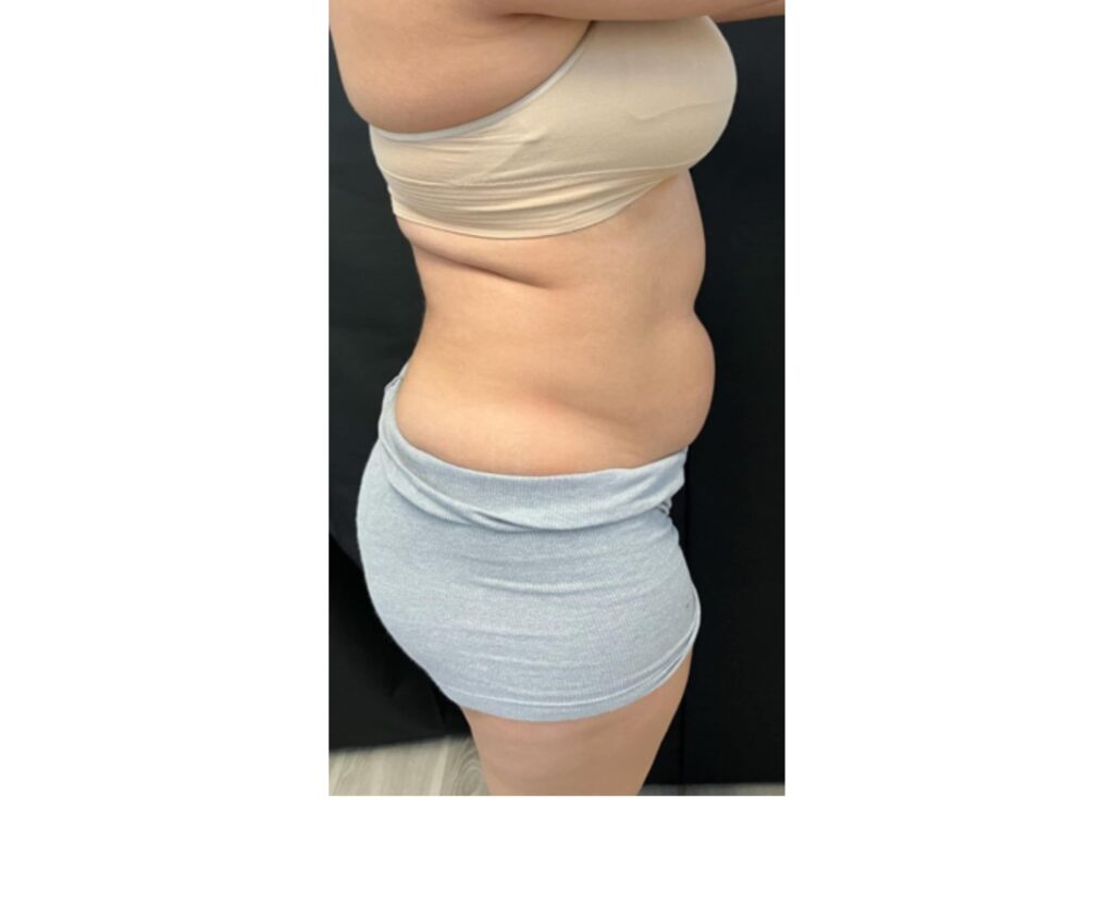 Mini Tummy Tuck with Lipo - Before