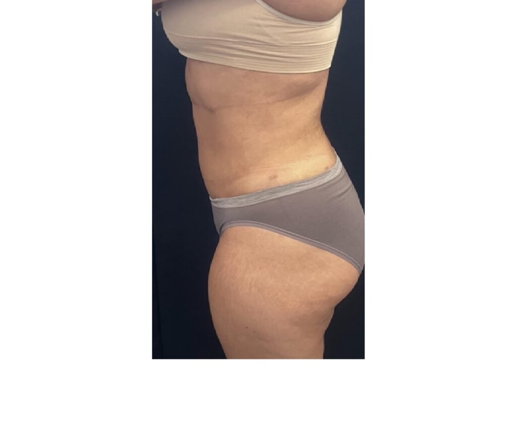 Mini Tummy Tuck with Lipo - After