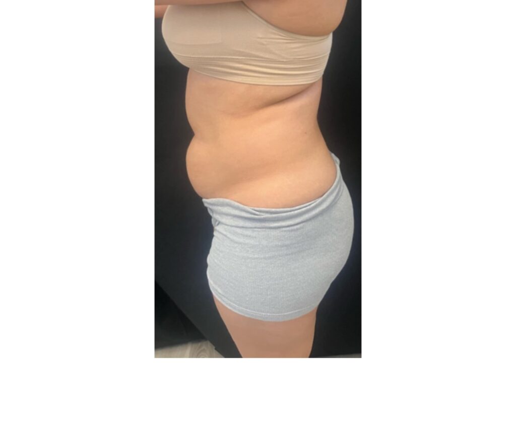 Mini Tummy Tuck with Lipo - Before
