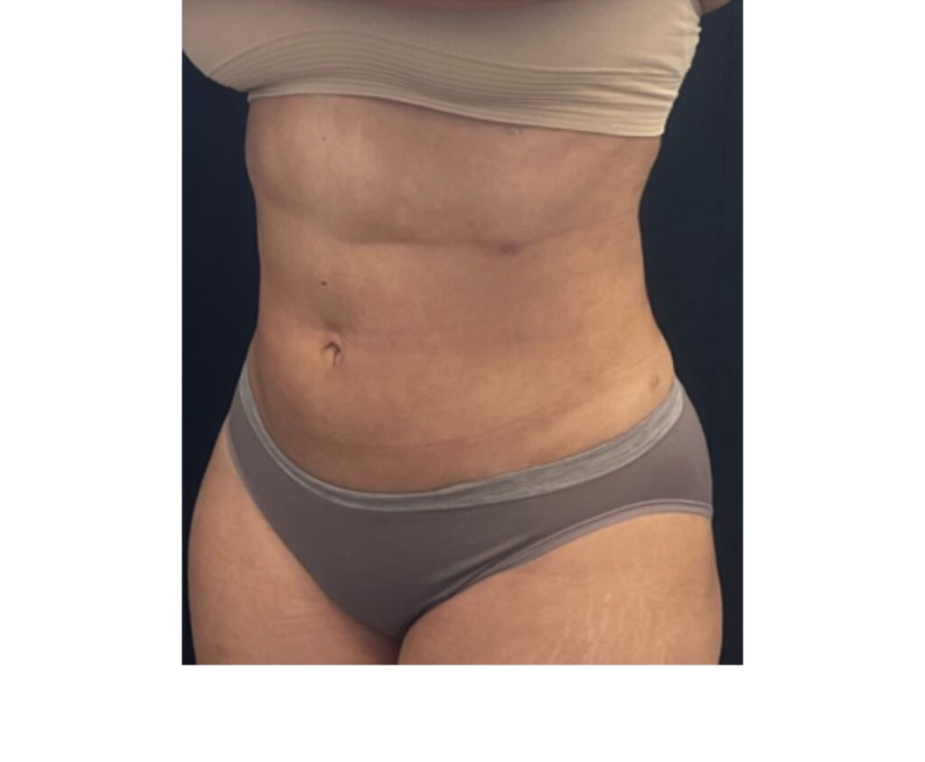 Mini Tummy Tuck with Lipo - After