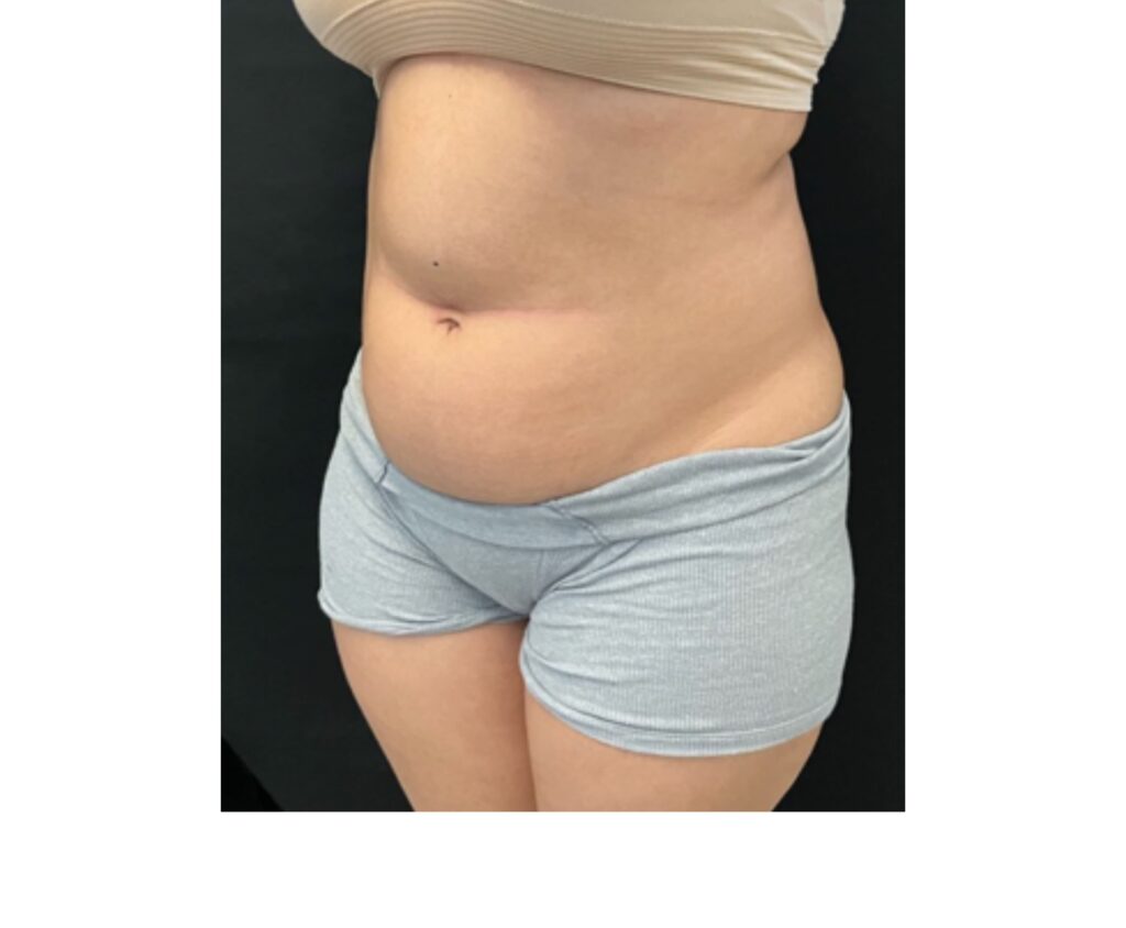 Mini Tummy Tuck with Lipo - Before