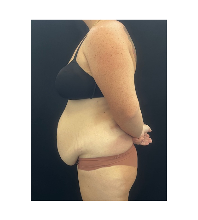 Hips and flanks