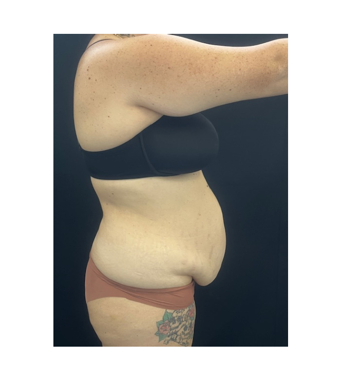 03 Hips and flanks