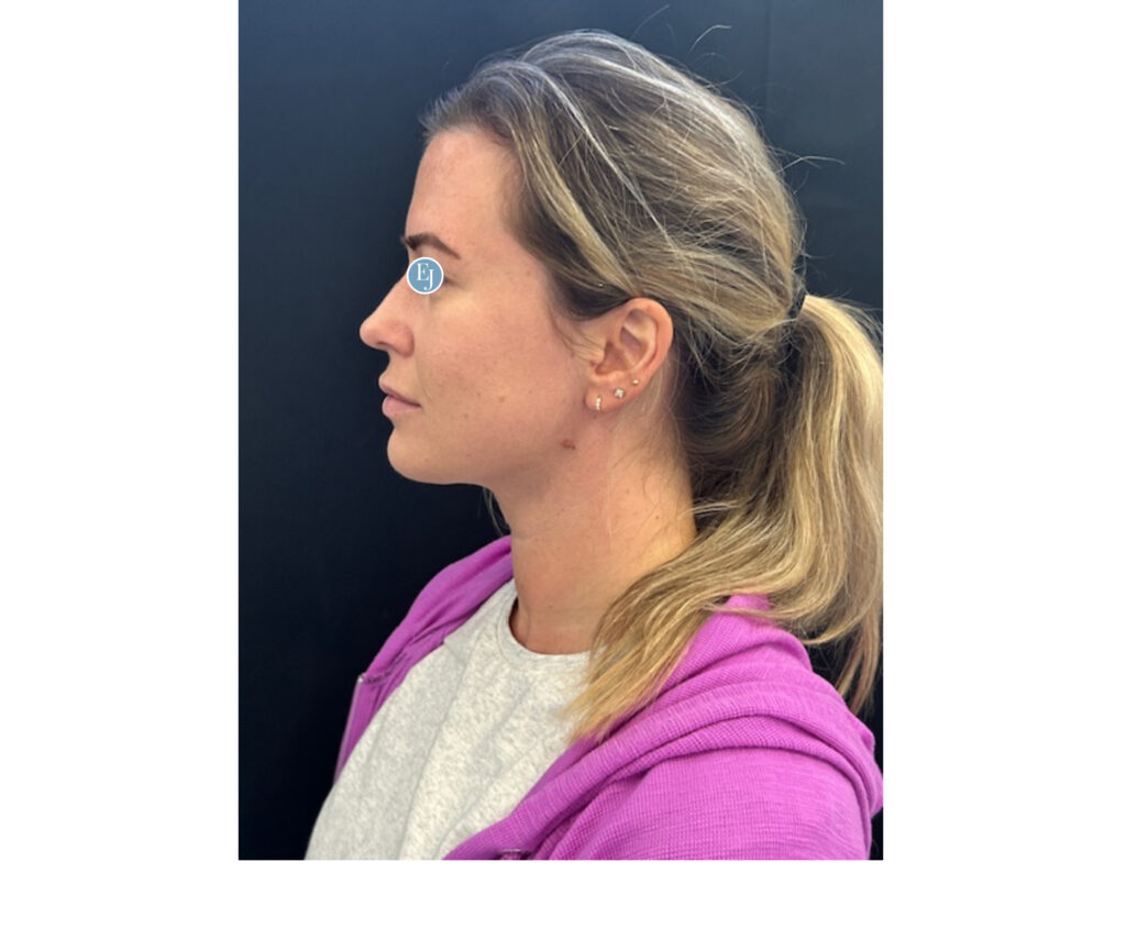 submental liposuction -after