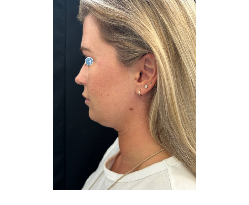 submental liposuction -before