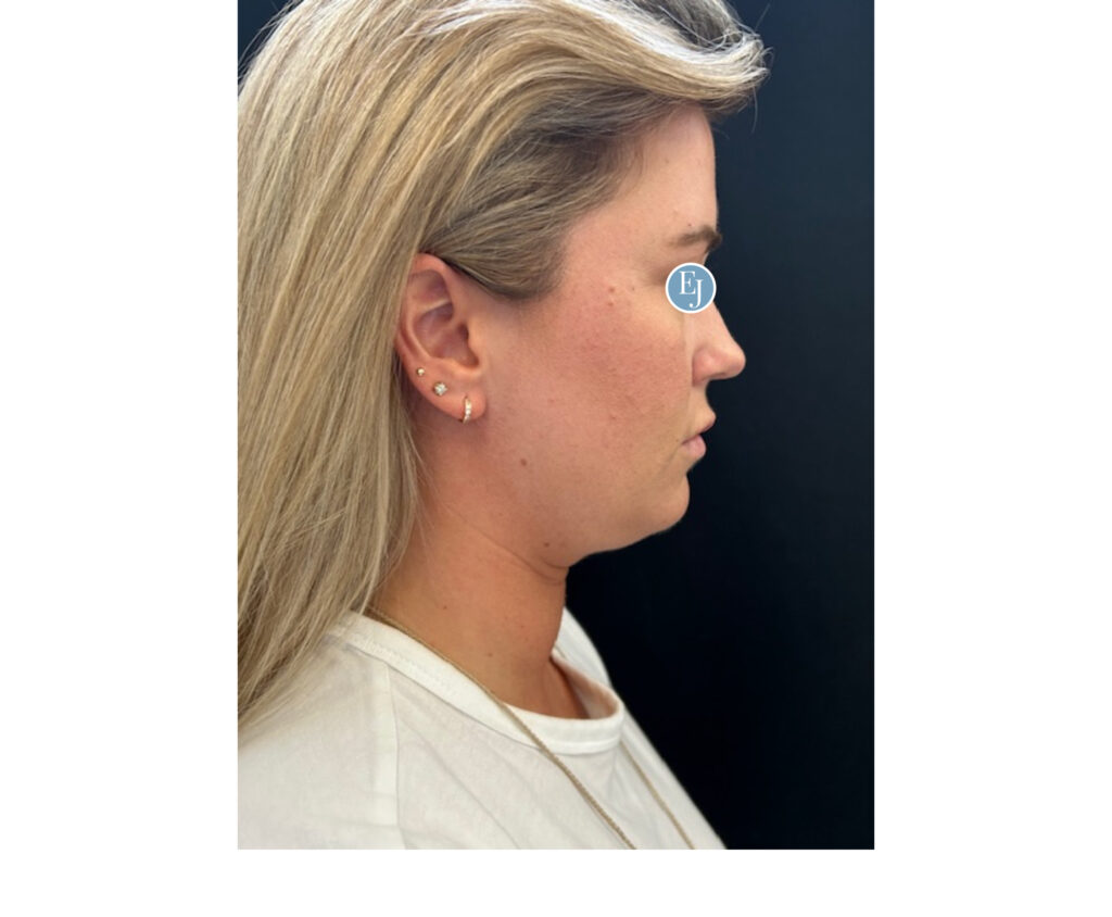 submental liposuction -before