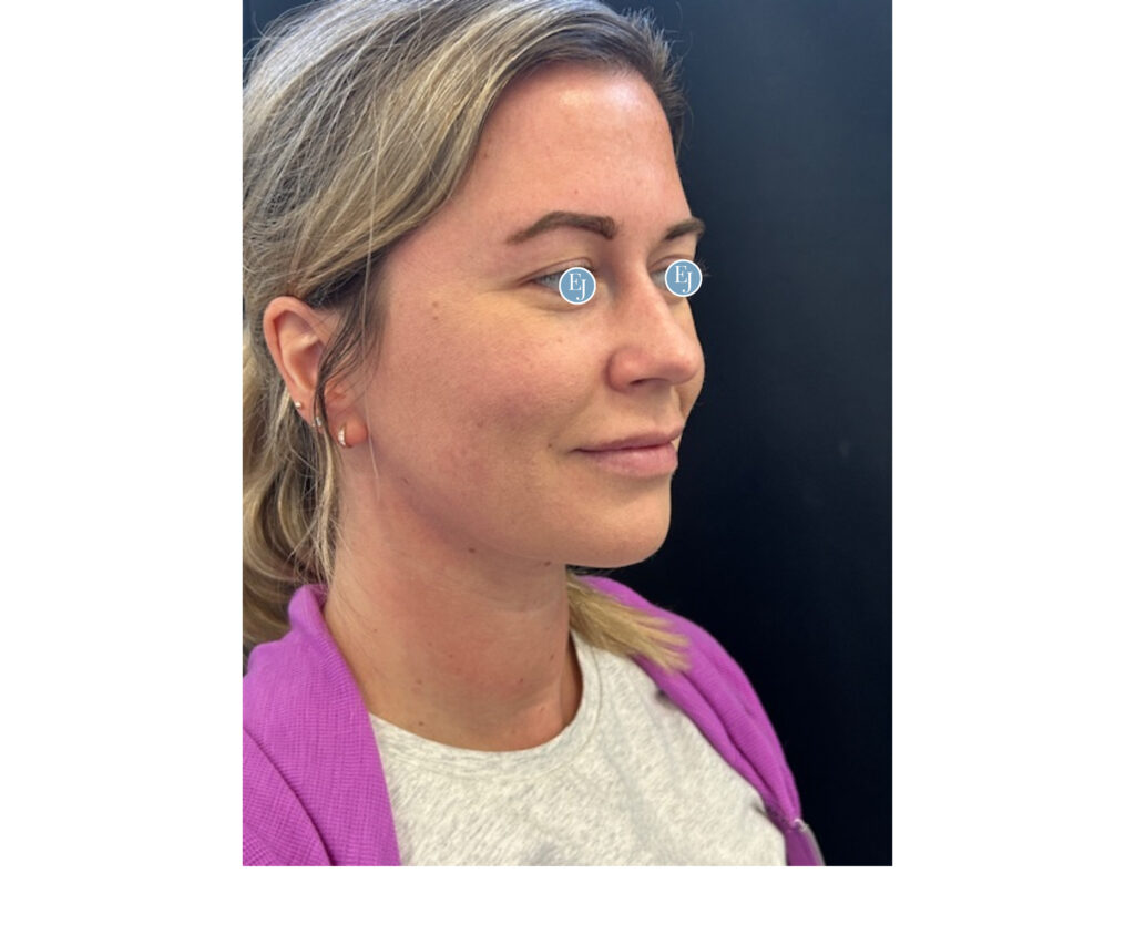 submental liposuction -after