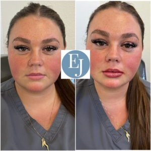 sarasota restylane before and after photo