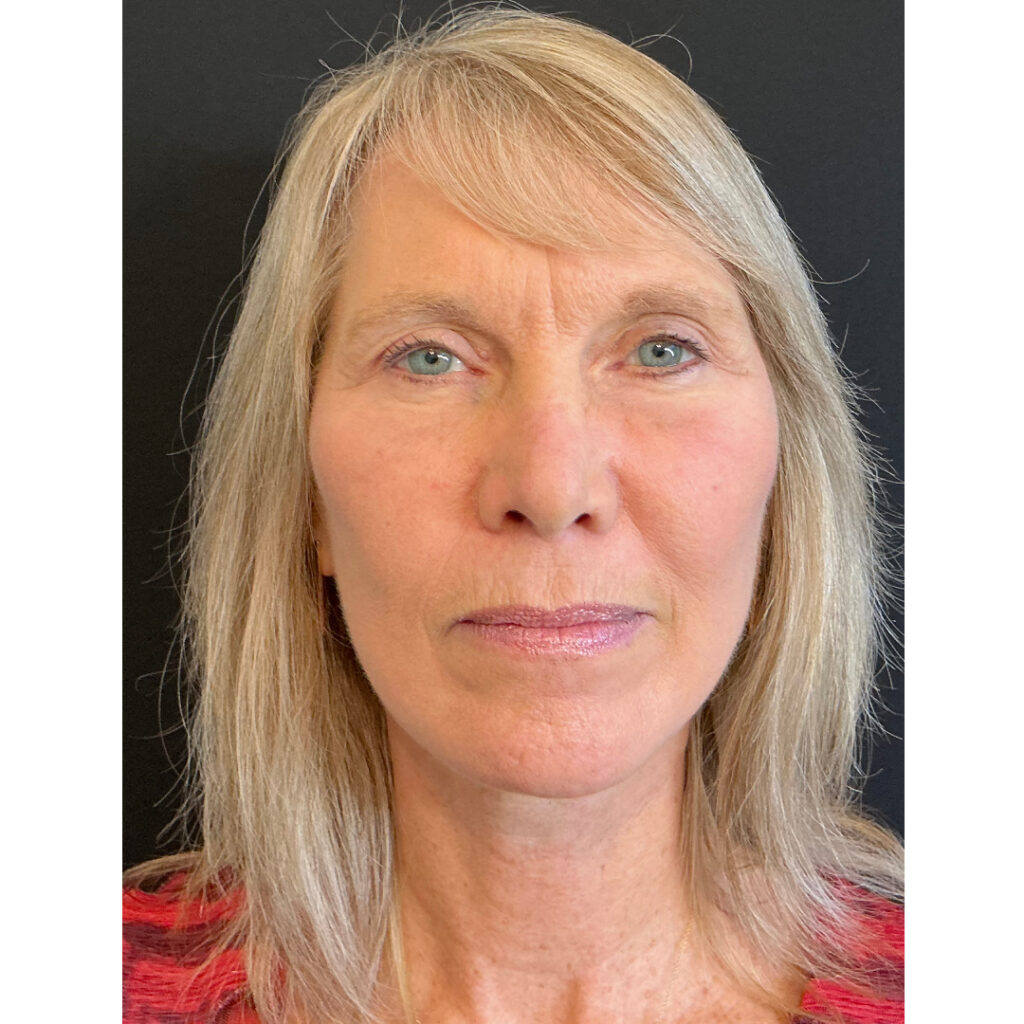 Face and Neck Lift - After
