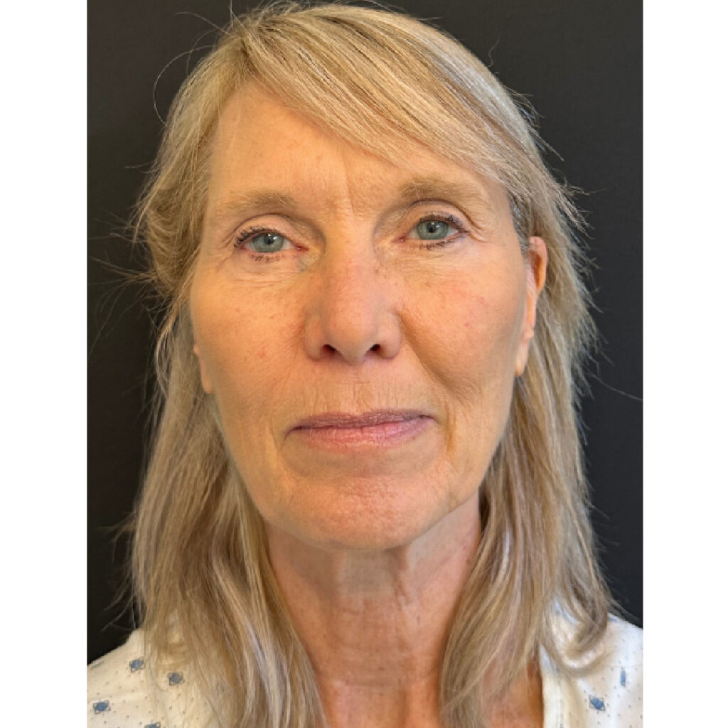 Face and Neck Lift - Before
