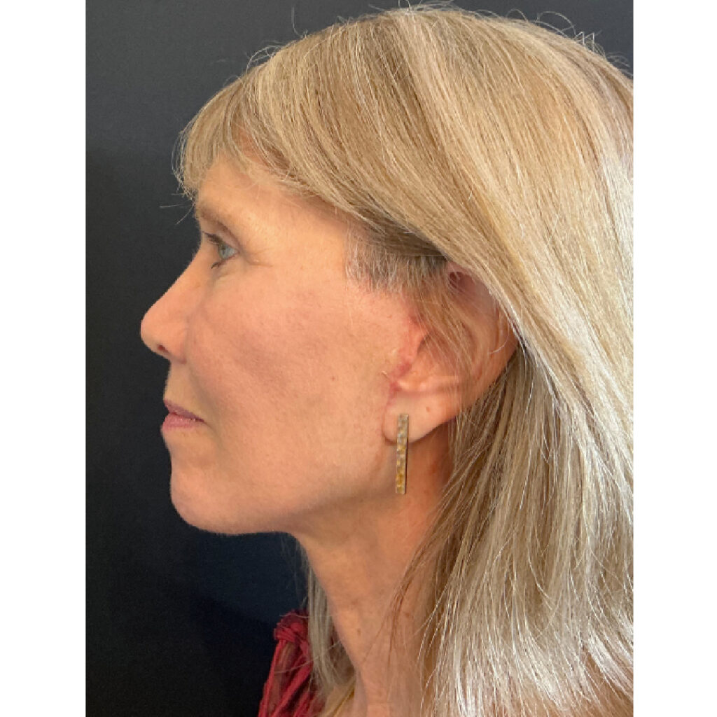 Face and Neck Lift - After