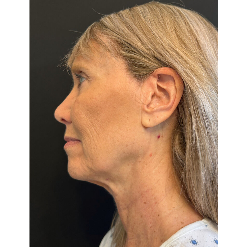 Face and Neck Lift - Before