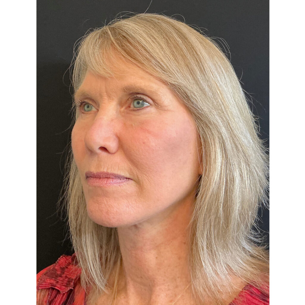 Face and Neck Lift - After
