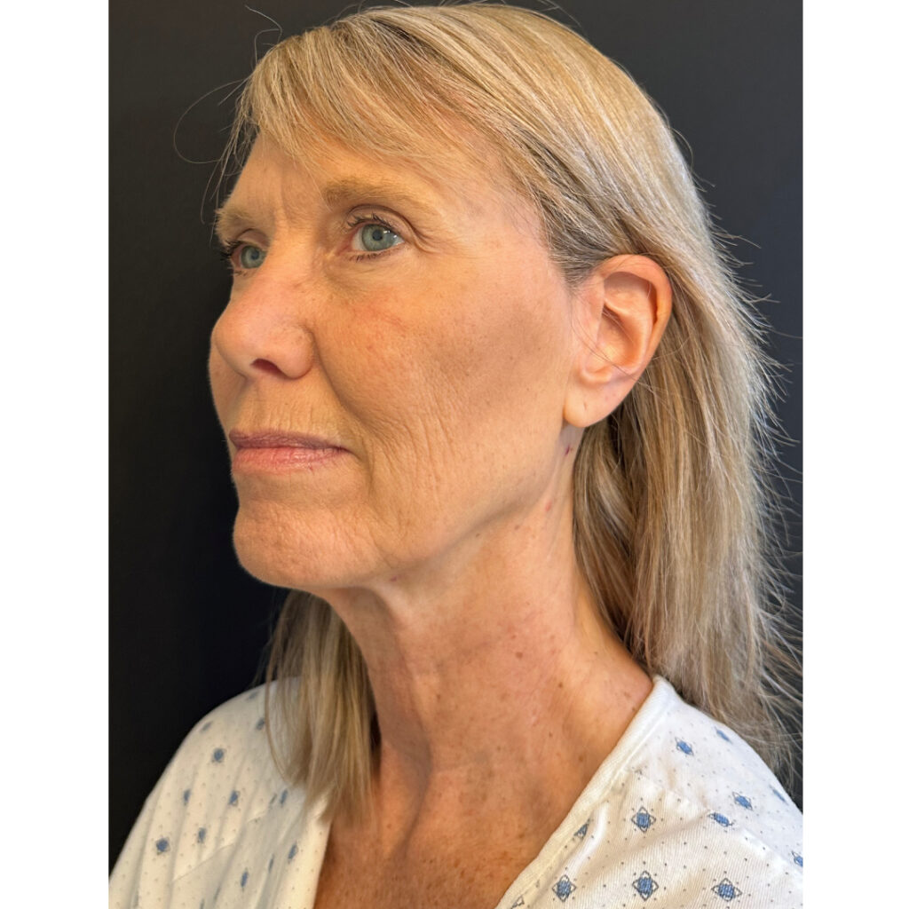 Face and Neck Lift - Before