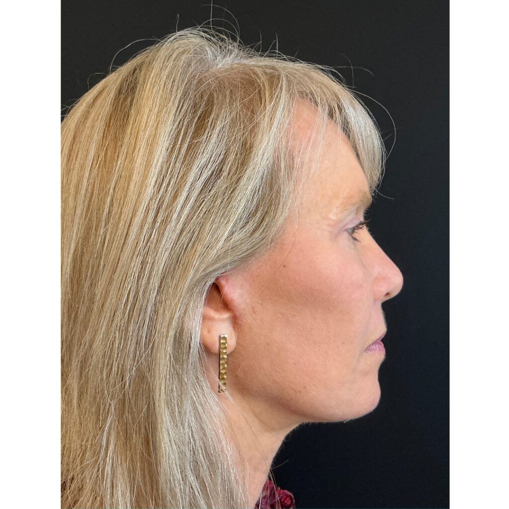 Face and Neck Lift - After