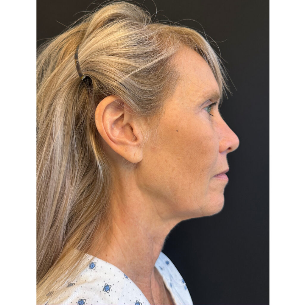 Face and Neck Lift - Before