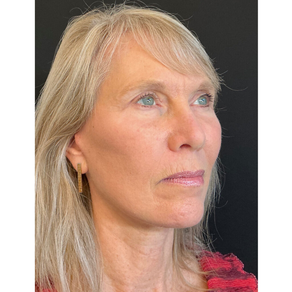 Face and Neck Lift - After
