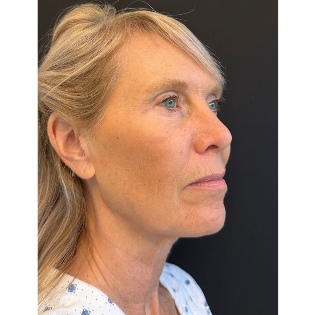 Face and Neck Lift - Before