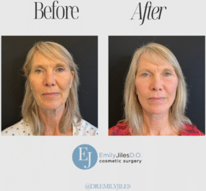 This stunning transformation features a face & neck lift paired with, blepharoplasty and full-face CO₂ laser for smoother skin and a beautifully refreshed look.