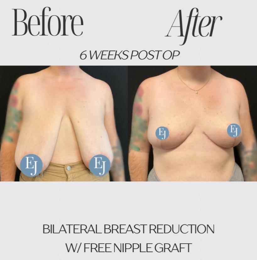 Sarasota Patient who had a bilateral breast reduction. This shows the before and 6 weeks after surgery.