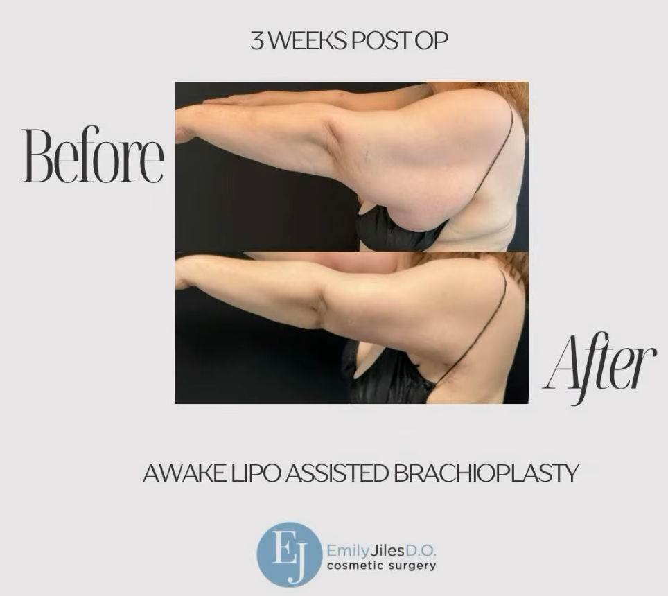 This before and after features an awake, liposuction assisted brachioplasty. At just 3 weeks post op, our patient is healing beautifully, and her results will continue to improve over the coming months.