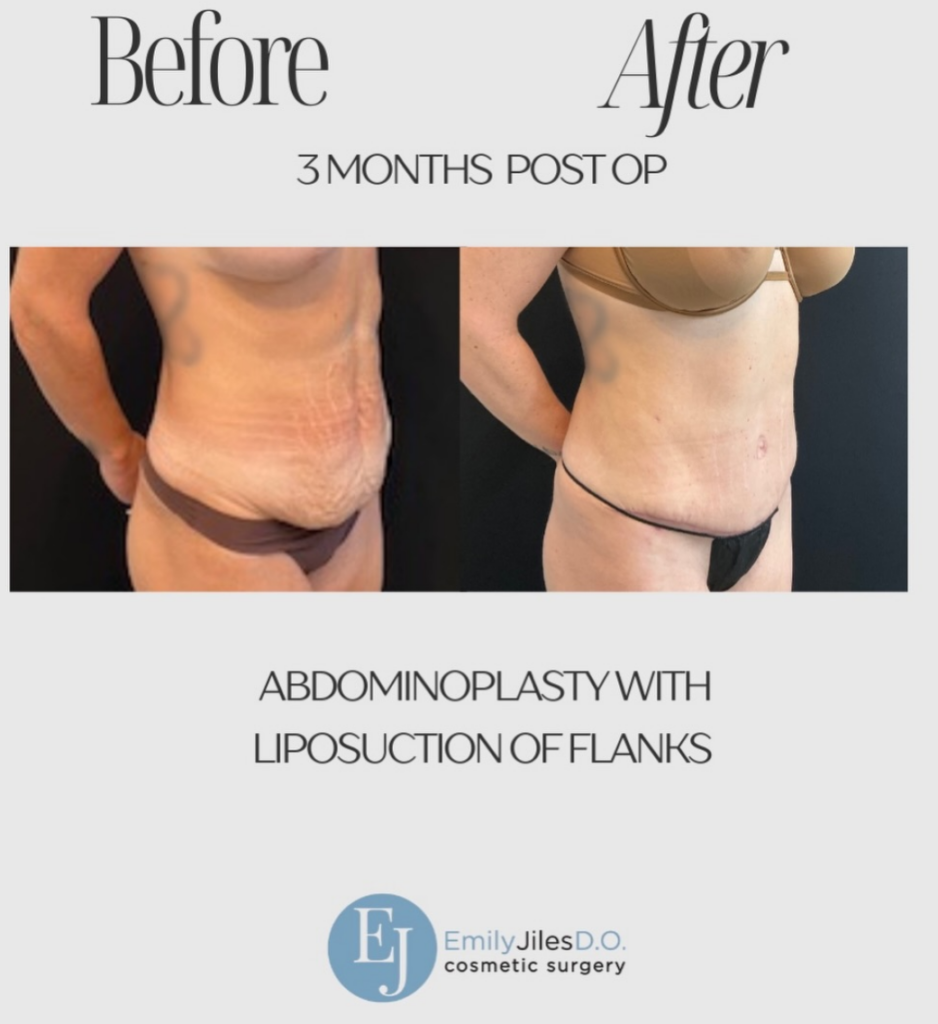 Three months post-op, and the transformation speaks for itself With a full tummy tuck and contoured liposuction, our patient reveals a silhouette that is smoother, more contoured, and defined.