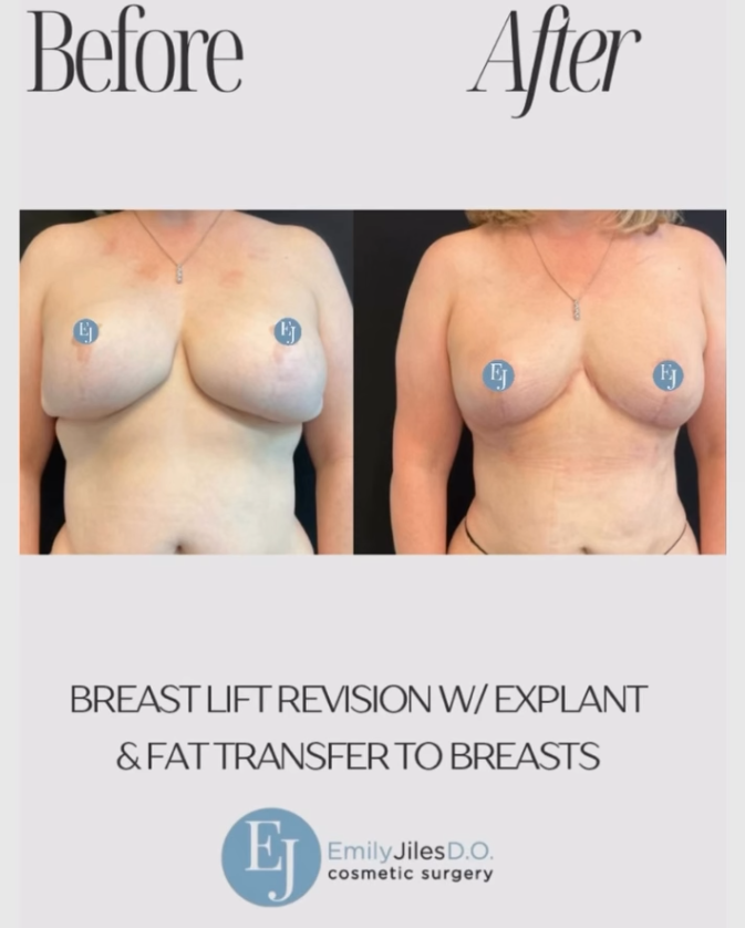 Every revision is unique, and the right approach depends on each patient’s anatomy, goals, and previous surgical history. For this patient, fat transfer was the best option to achieve her desired result